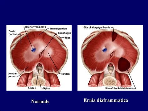 Diagramma che illustra la chirurgia fetale per ernia diaframmatica