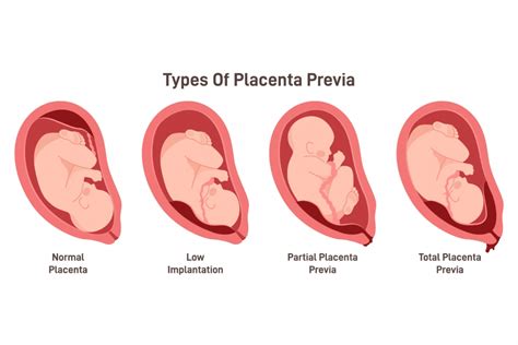Diagramma della placenta previa vs placenta normale