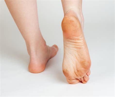 Piedi con calli e duroni