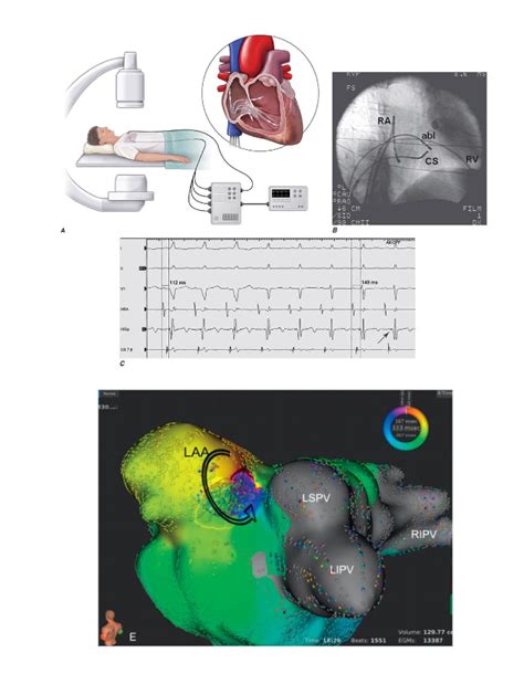 Esempio di mappaggio elettroanatomico 3D del cuore durante uno studio elettrofisiologico