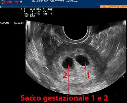 Ecografia di gravidanza gemellare con due sacchi vitellini