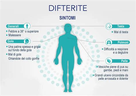 Illustrazione della gola affetta da difterite con membrana grigiastra