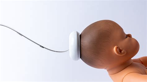 Immagine che illustra l'uso della ventosa ostetrica
