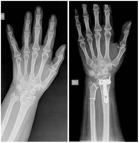 Radiografia di una pseudoartrosi dell'ulna con placca metallica mobilizzata