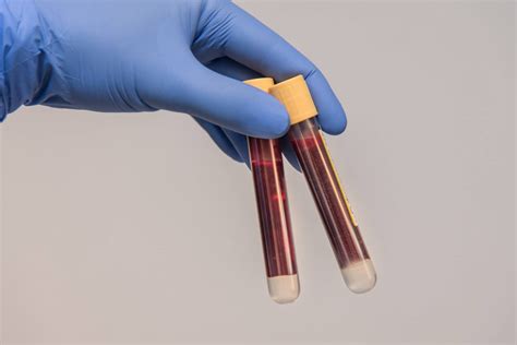 Prelievo di sangue materno