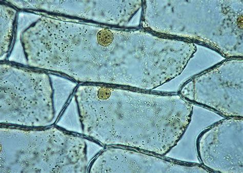 Immagine al microscopio di cellule LSIL