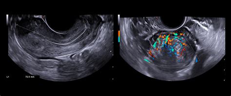Ecografia uterina con evidenza di residui post-abortivi
