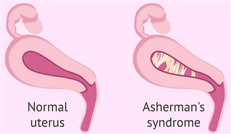Diagramma che illustra la Sindrome di Asherman