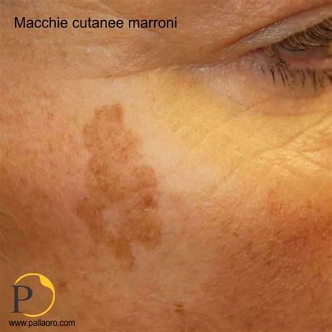 macchie caffelatte sulla pelle di un bambino