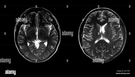risonanza magnetica cerebrale che mostra uno schwannoma acustico