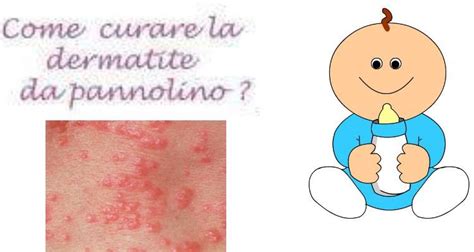 Infografica sulle cause della dermatite da pannolino e consigli per la prevenzione