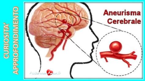 Aneurisma cerebrale e sue cause