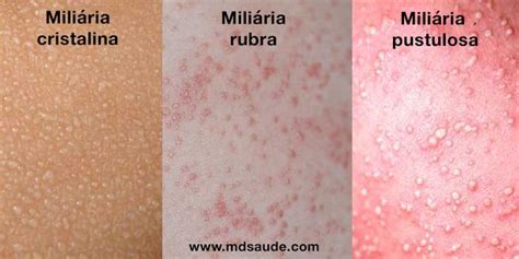 tipi di miliaria (cristallina, rubra, profonda)