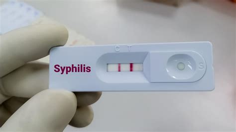 Schema dei test sierologici per la sifilide