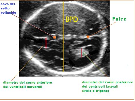 Misurazione BPD ecografia morfologica