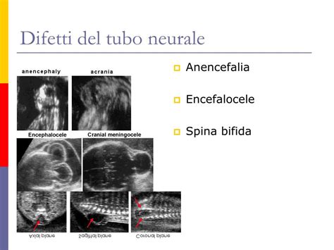 Tipi di difetti del tubo neurale