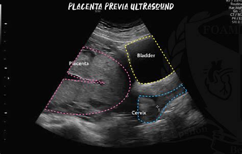 Ecografia transvaginale per placenta previa