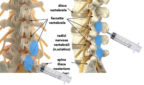Immagine che illustra la riduzione del volume di un'ernia discale trattata con ozonoterapia