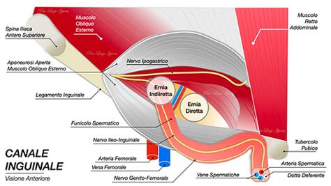 diagramma di confronto tra idrocele ed ernia inguinale