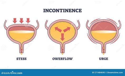 Diagramma che illustra le diverse tipologie di incontinenza urinaria