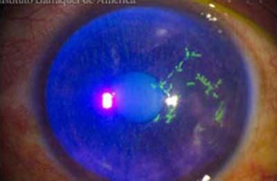 Ulcera dendritica della cornea