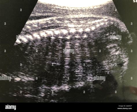 Ecografia fetale che mostra assenza di battito cardiaco