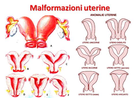 Diagramma delle malformazioni uterine