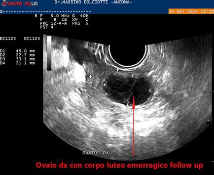corpo luteo emorragico ecografia