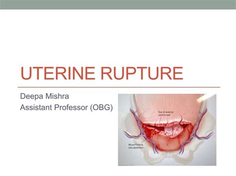 uterine rupture diagram