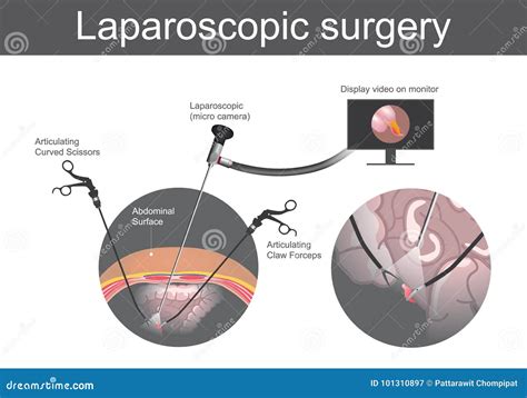 Laparoscopic surgery illustration