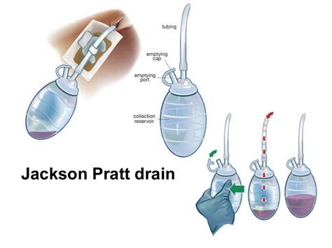 Drenaggio Redon e Jackson-Pratt