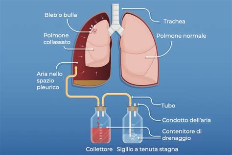 Cura e gestione del drenaggio
