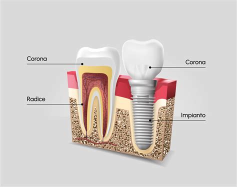 Microstruttura di un impianto dentale in titanio e la sua interfaccia con l'osso