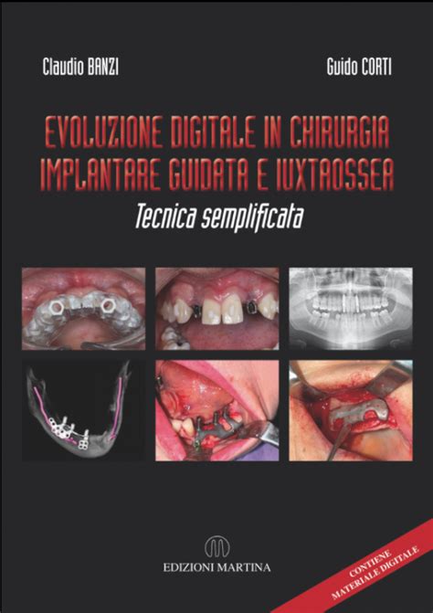 Flusso di lavoro della chirurgia implantare guidata