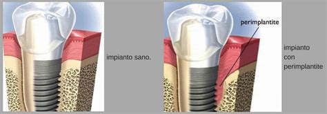 Confronto tra un impianto dentale sano e un impianto affetto da perimplantite