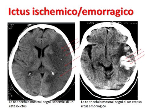 Incidenza di ictus ischemico per fascia d'età