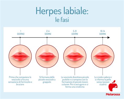 Infografica sulle fasi dell'herpes labiale e i rimedi