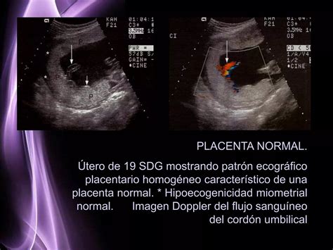 Ecografia di una placenta sana