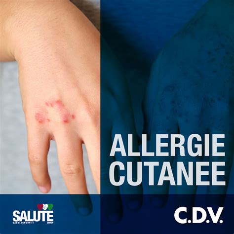 infografica che spiega la differenza tra orticaria infettiva e allergia da farmaci