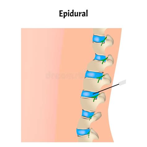 illustrazione scientifica del funzionamento dell'epidurale durante il parto
