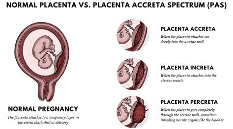 Confronto tra placenta accreta, increta e percreta