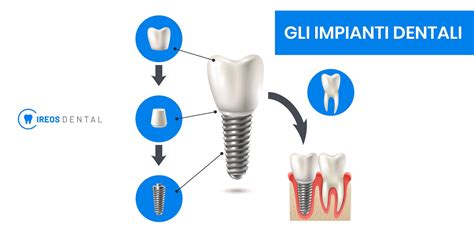 Impianti dentali e gravidanza