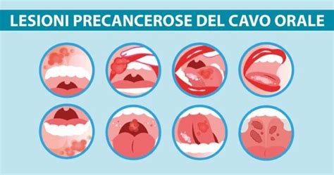 Infografica: Sintomi comuni di infiammazione della gola e del cavo orale