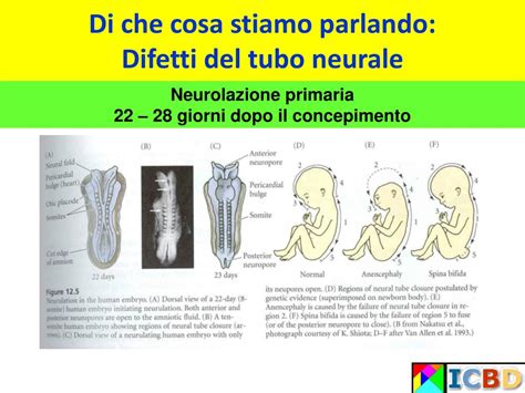 Diagramma che illustra i difetti del tubo neurale