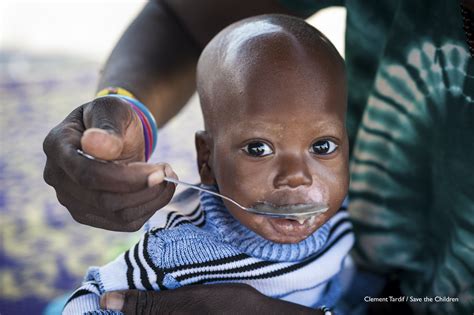 bambini malnutriti in Africa