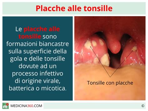 Diagramma delle tonsille e placche