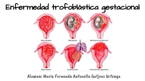 Diagramma che illustra l'origine dei diversi tipi di Malattia Trofoblastica Gestazionale