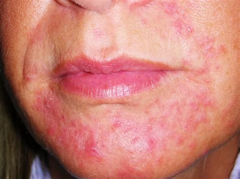Dermatite periorale con arrossamento e papule