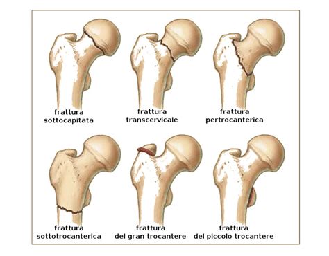 Epidemiologia delle fratture del femore prossimale