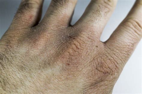 Mani irritate e screpolate che vengono massaggiate con una pasta lenitiva a base di amido di riso